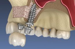 ! Reguli de urmat după operația de sinus lift !